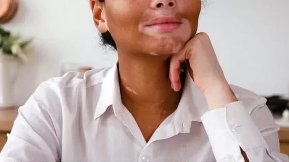 విటిలిగో