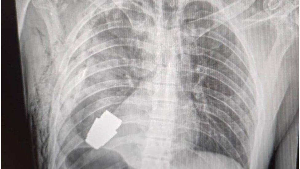 ఛాతిలో గ్రెనెడ్