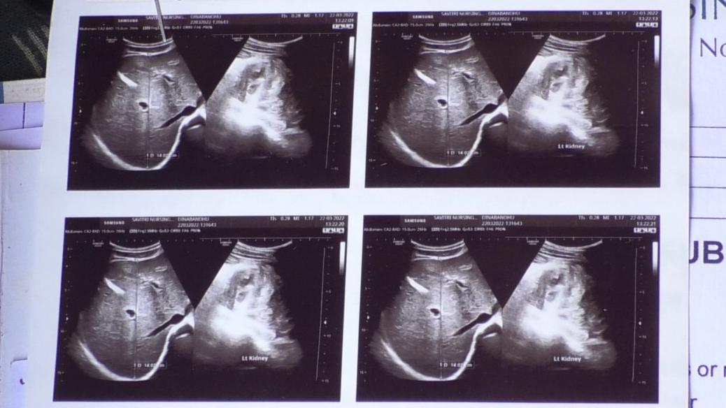 కిడ్నీ వ్యాధి ఎక్స్రే కిడ్నీ వ్యాధి ఎక్స్రే