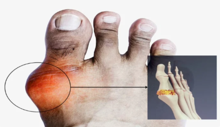 ದೇಹದಲ್ಲಿ ಯೂರಿಕ್ ಆಸಿಡ್ ಹೆಚ್ಚಾದ್ರೆ ಪಾದಗದಲ್ಲಿ ಹೀಗೆ ಆಗುತ್ತೆ ಎಚ್ಚರ