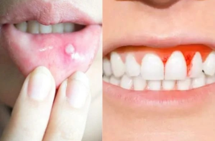 ವಸಡು ದೌರ್ಬಲ್ಯ, ಒಸಡುಗಳಲ್ಲಿ ಕೀವು ತುಂಬುವುದು, ಒಸಡುಗಳಲ್ಲಿ ರಕ್ತಸ್ರಾವ ಇತ್ಯಾದಿಗೆ ಆಲಂ ಪ್ರಯೋಜನಕಾರಿಯಾಗಿದೆ.