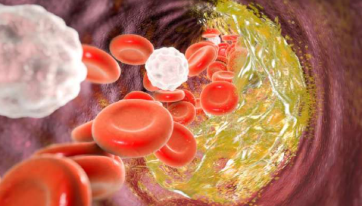 ದೇಹದಲ್ಲಿ ಕೆಟ್ಟ ಕೊಲೆಸ್ಟ್ರಾಲ್ ಸಂಗ್ರಹವಾದಾಗ, ಅದು ಮೂತ್ರದಲ್ಲಿ ಹರಳುಗಳ ರೂಪದಲ್ಲಿ ಹೊರಬರಲು ಪ್ರಾರಂಭಿಸುತ್ತದೆ. ಕೊಲೆಸ್ಟ್ರಾಲ್ ಹರಳುಗಳು ಗಾತ್ರದಲ್ಲಿ ಚಿಕ್ಕದಾಗಿದ್ದರೆ ಮೂತ್ರದ ಮೂಲಕ ಹೋಗುವುದು ಸಹಜ. ಆದರೆ ಇದರ ಗಾತ್ರ ಹೆಚ್ಚಾದಂತೆ ಕಿಡ್ನಿ ಹಾನಿಯಾಗುವ ಅಪಾಯವಿದೆ.