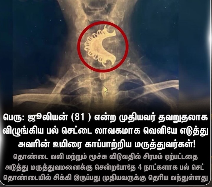 முதியவரின் தொண்டையில் சிக்கிய பல் செட்!