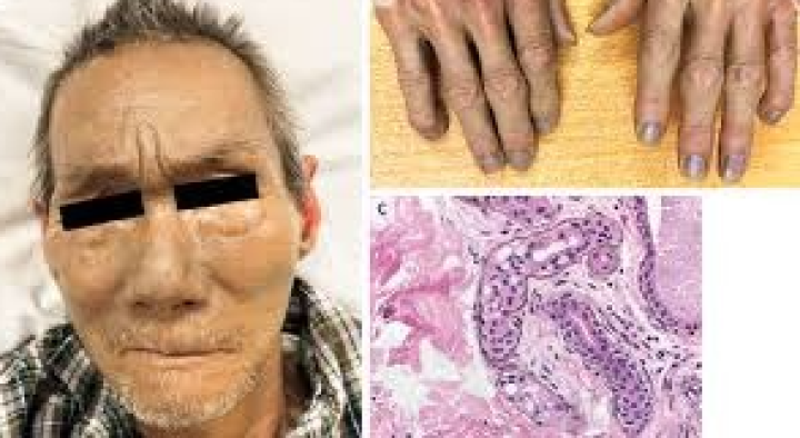 হাতের আঙুল ও নখের রং বদলে যাচ্ছিল ধীরে ধীরে। নীলচে ধূসর থেকে গাঢ় ধূসর রঙে বদলে যাচ্ছিল হাত ও পায়ের রংও।বিরল ‘আর্জিরিয়া’ রোগের চিহ্ন এটি।