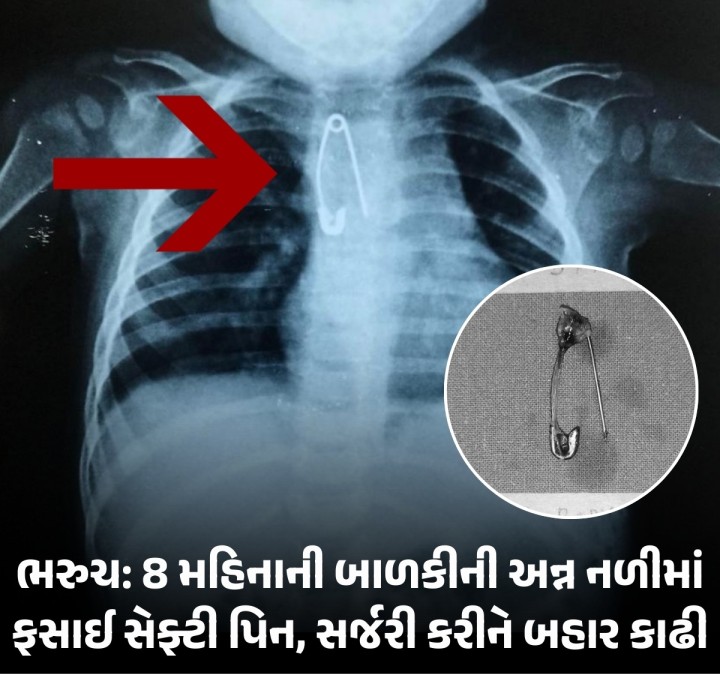 ભરુચ જિલ્લાના જંબુસર તાલુકાના નડિયાદ ગામની રહેવાસી ફક્ત આઠ મહિનાની બાળકી જેનું વજન માત્ર 5.65 કિલોગ્રામ છે તે ને ત્રણ દિવસથી મોઢામાંથી લોહી નીકળવાની સમસ્યા સાથે એસએસજી હોસ્પિટલનાં બાળકોનાં વિભાગમાં તારીખ 19 ફેબ્રુઆરી,2025ના રોજ ના સવારે સારવાર માટે દાખલ કરવામાં આવી હતી બાળકીનાં શરીરમાં હિમોગ્લોબિનનું પ્રમાણ ઓછું એટલે કે ફક્ત 5 % હતું, તદુપરાંત તે સિકલ સેલ એનીમિયાથી પીડિત પણ જાણવા �