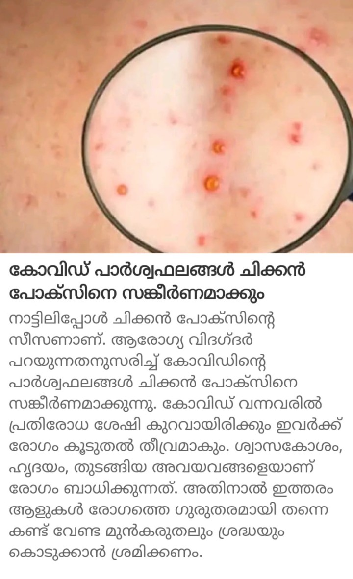 കോവിഡ് പാർശ്വഫലങ്ങൾ ചിക്കൻ പോക്സിനെ സങ്കീർണമാക്കും