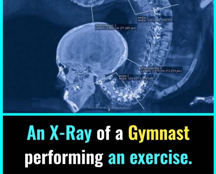X-Ray of a Gymnast.