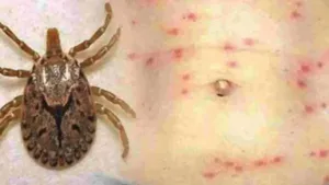 Scrub Typhus Cases Rise In Andhra Pradesh What Is It How It Spreads Symptoms And Prevention Exp 011 7932251.html