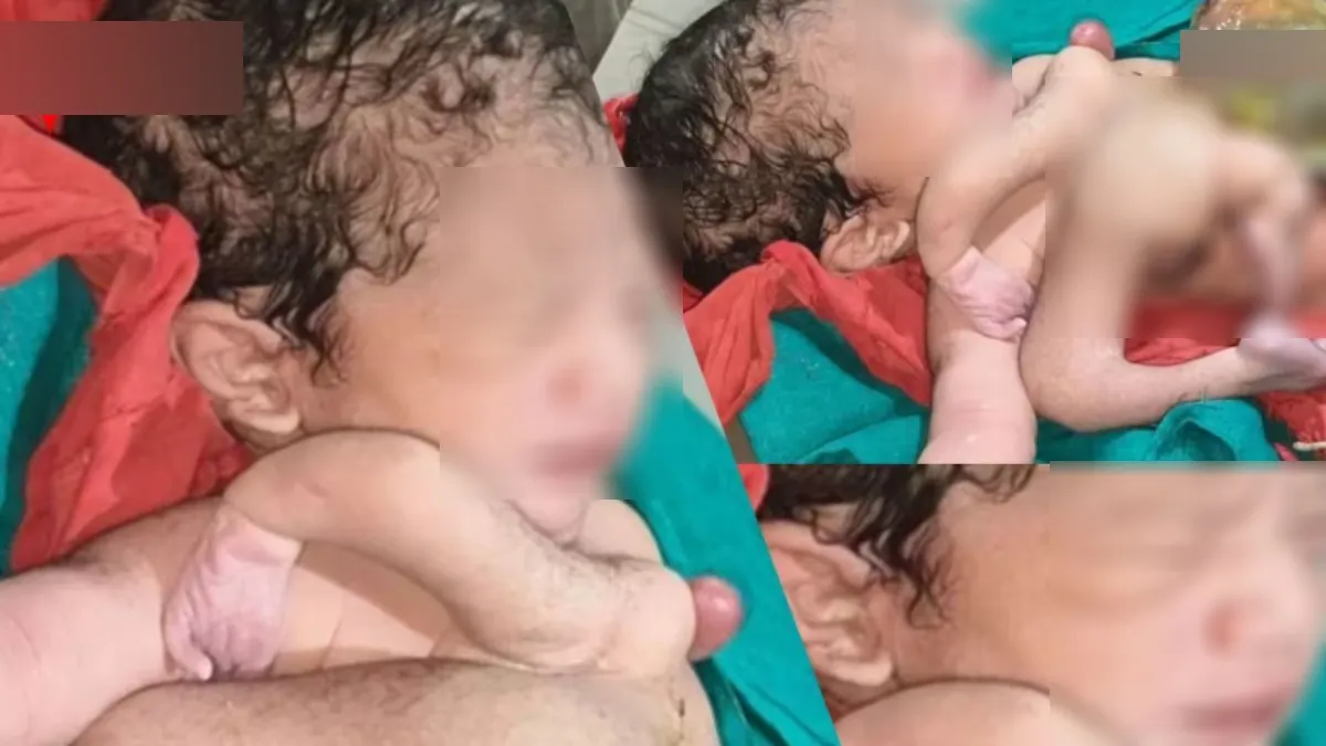 பிறந்த குழந்தையை பார்த்து அதிர்ந்த டாக்டர்கள்.. 4 கைகள், 4 கால்கள்! மத்திய பிரதேசத்தில் நடந்தது என்ன