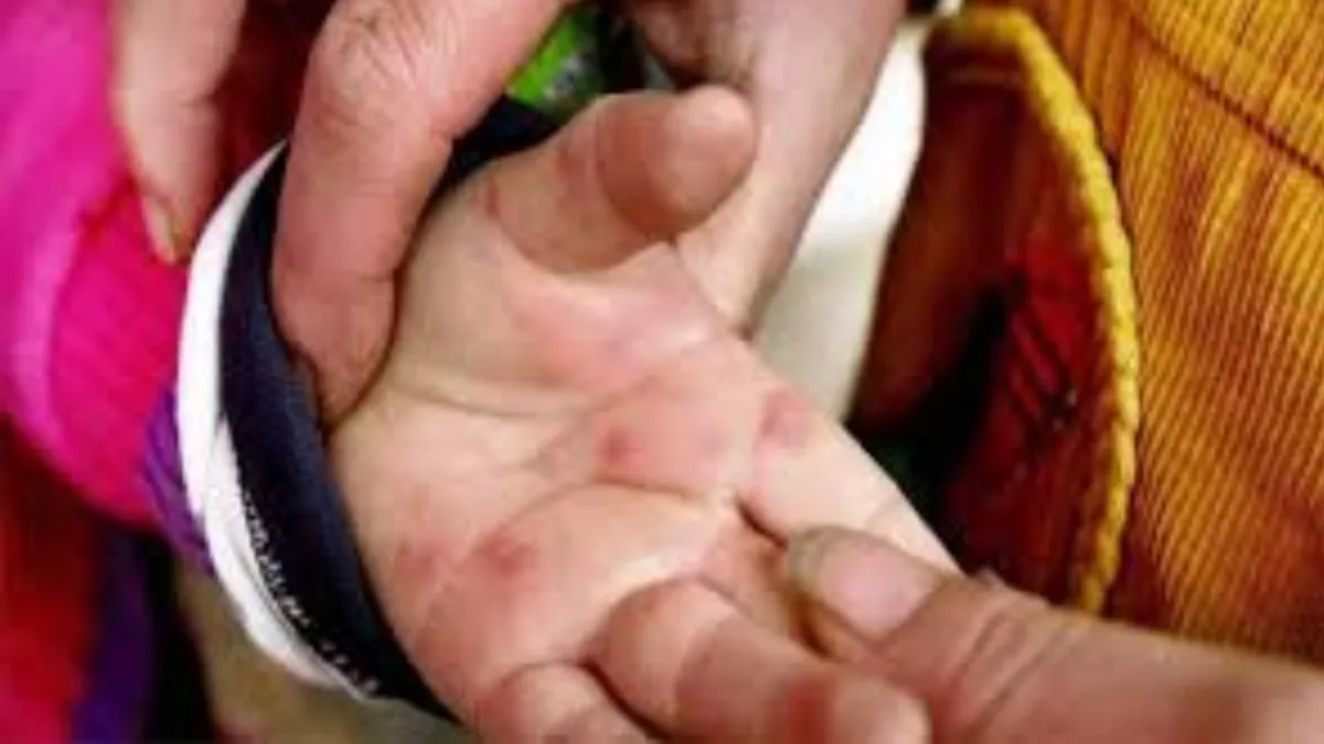 టమోటా వైరస్ కలకలం.. 12 ఏళ్ల లోపు చిన్నారులు బీ కేర్ ఫుల్ !